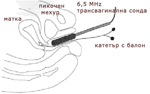 Какво представлява сонохистерографията (хидротубацията)?