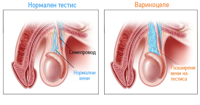 Варикозно разширение на вената на семенния канал (варикоцеле)